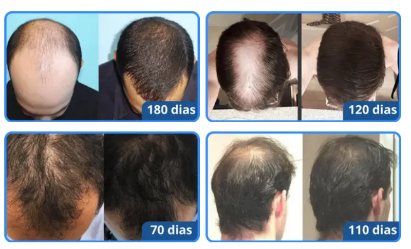 A Fase de Shedding: Entendendo a Perda Temporária de Fios - inspiração 2