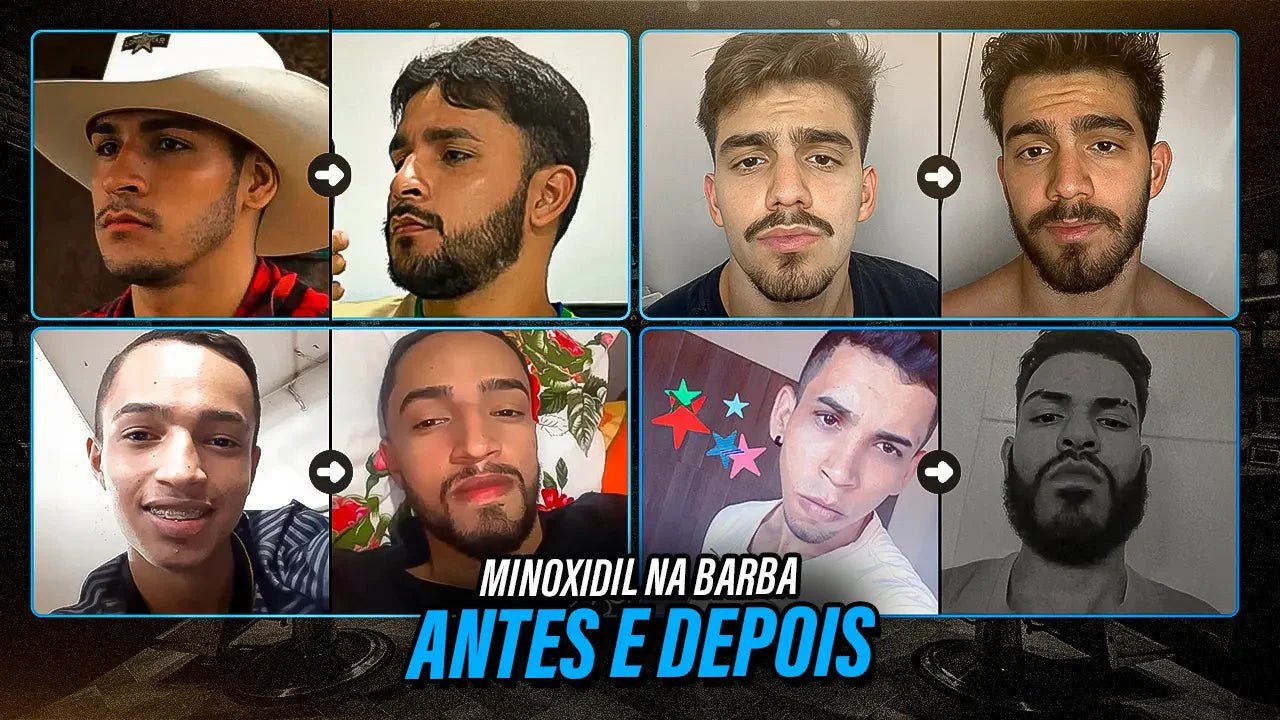 Ciclo de Tratamento: Por Quanto Tempo Usar o Minoxidil? - inspiração 1