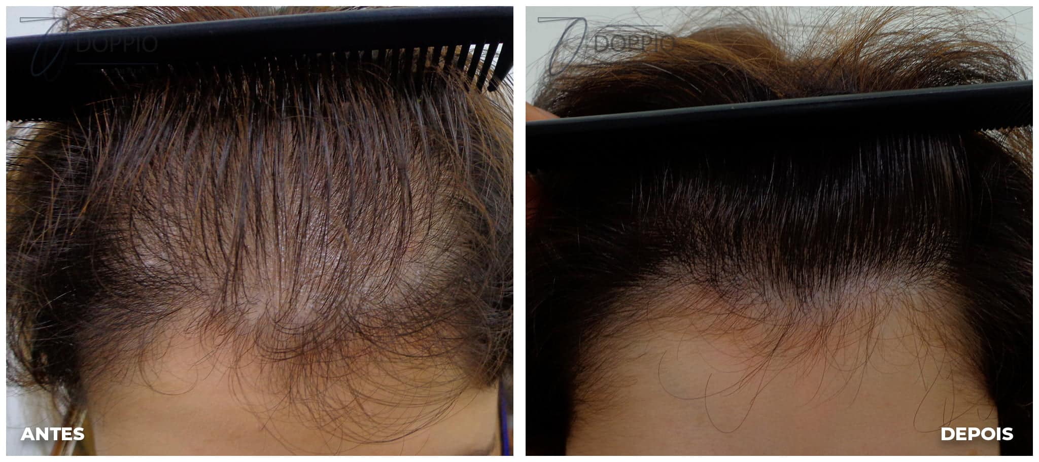 Além do Cabelo: Outras Áreas que Podem Apresentar Crescimento (e Como Lidar) - inspiração 1