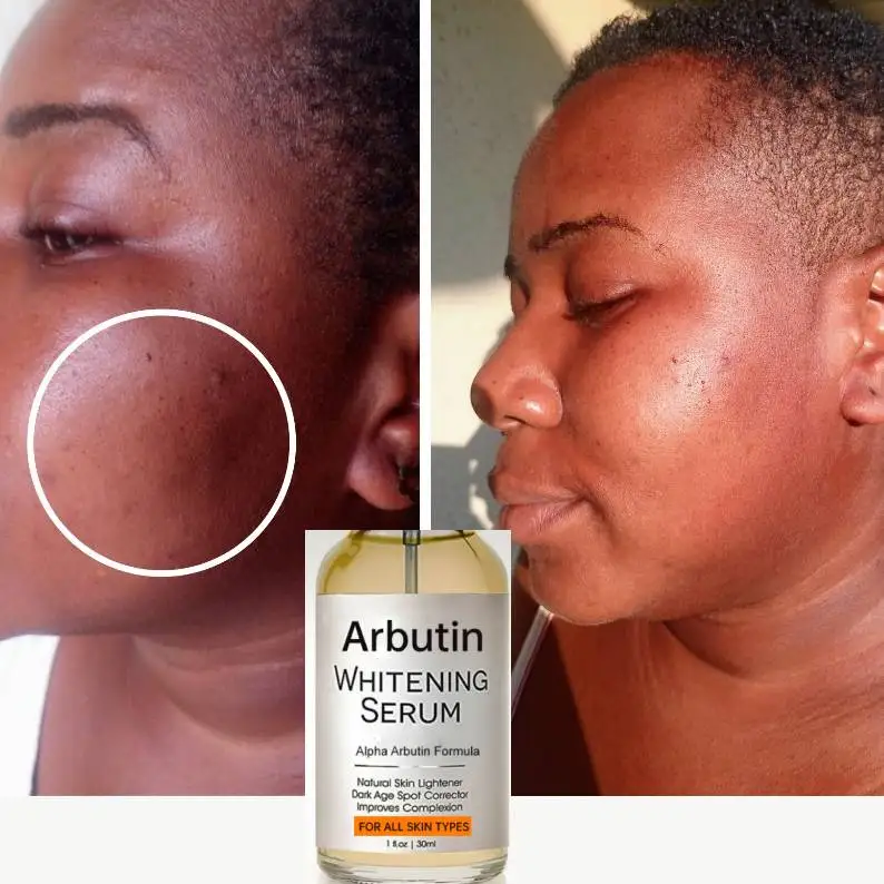 Como o Alfa-Arbutin age na pele?