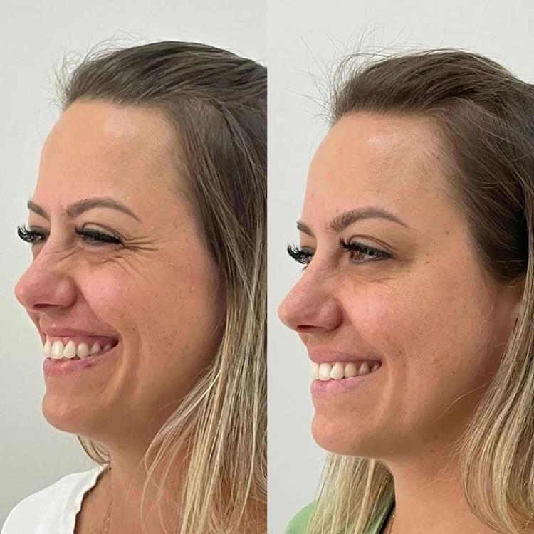 Botox Preventivo: Quando começar e quais os benefícios?