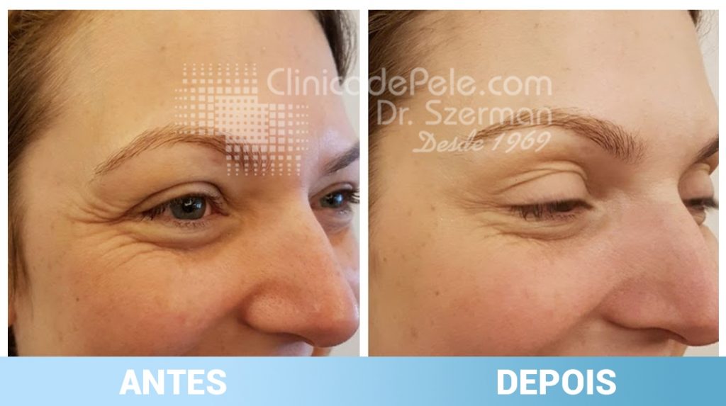 Botox vs. Preenchimento: Qual o melhor para você?