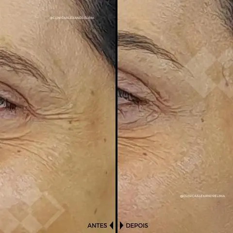 Botox Full Face: Entenda a técnica e seus resultados