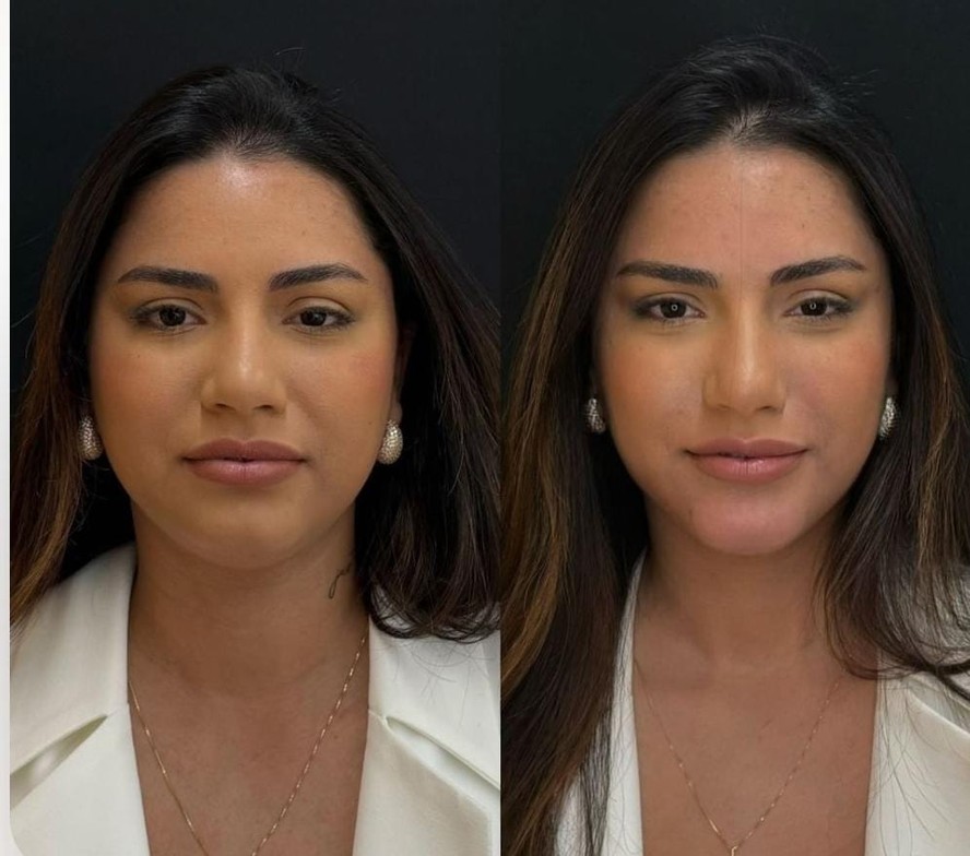 Mitos e Verdades sobre o Botox: Desvendando os segredos da toxina botulínica