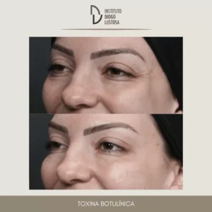Cuidados Essenciais Pós-Botox: Garanta a durabilidade do seu tratamento
