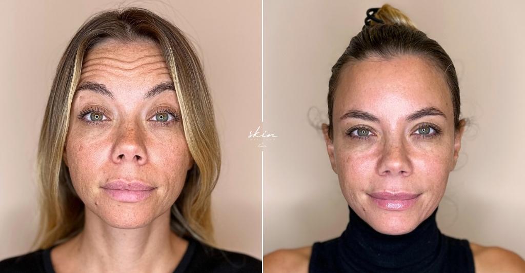 Botox Full Face: Entenda a técnica e seus resultados