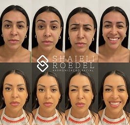 Cuidados Essenciais Pós-Botox: Garanta a durabilidade do seu tratamento