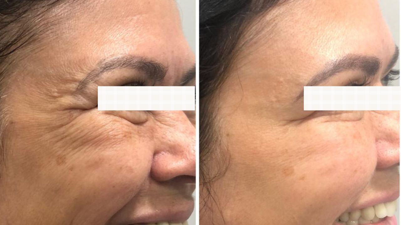 Botox Full Face: Entenda a técnica e seus resultados