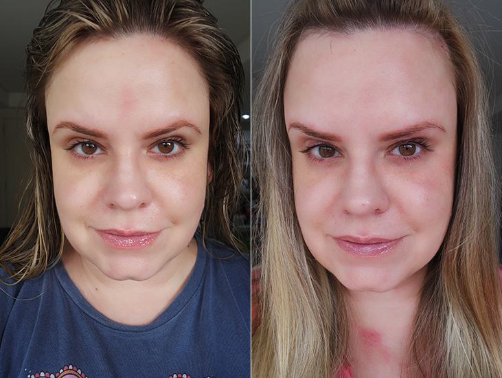 Mitos e Verdades sobre o Botox: Desvendando os segredos da toxina botulínica