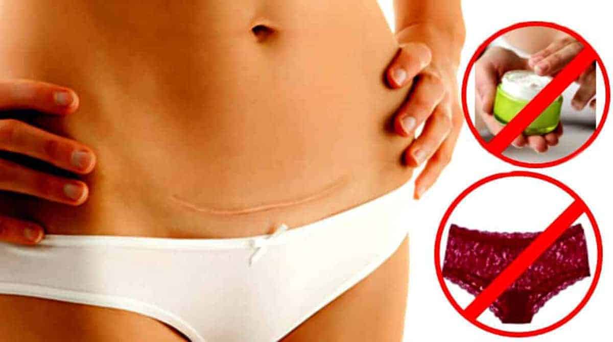 Apos Cesarea Pode Subir Escada