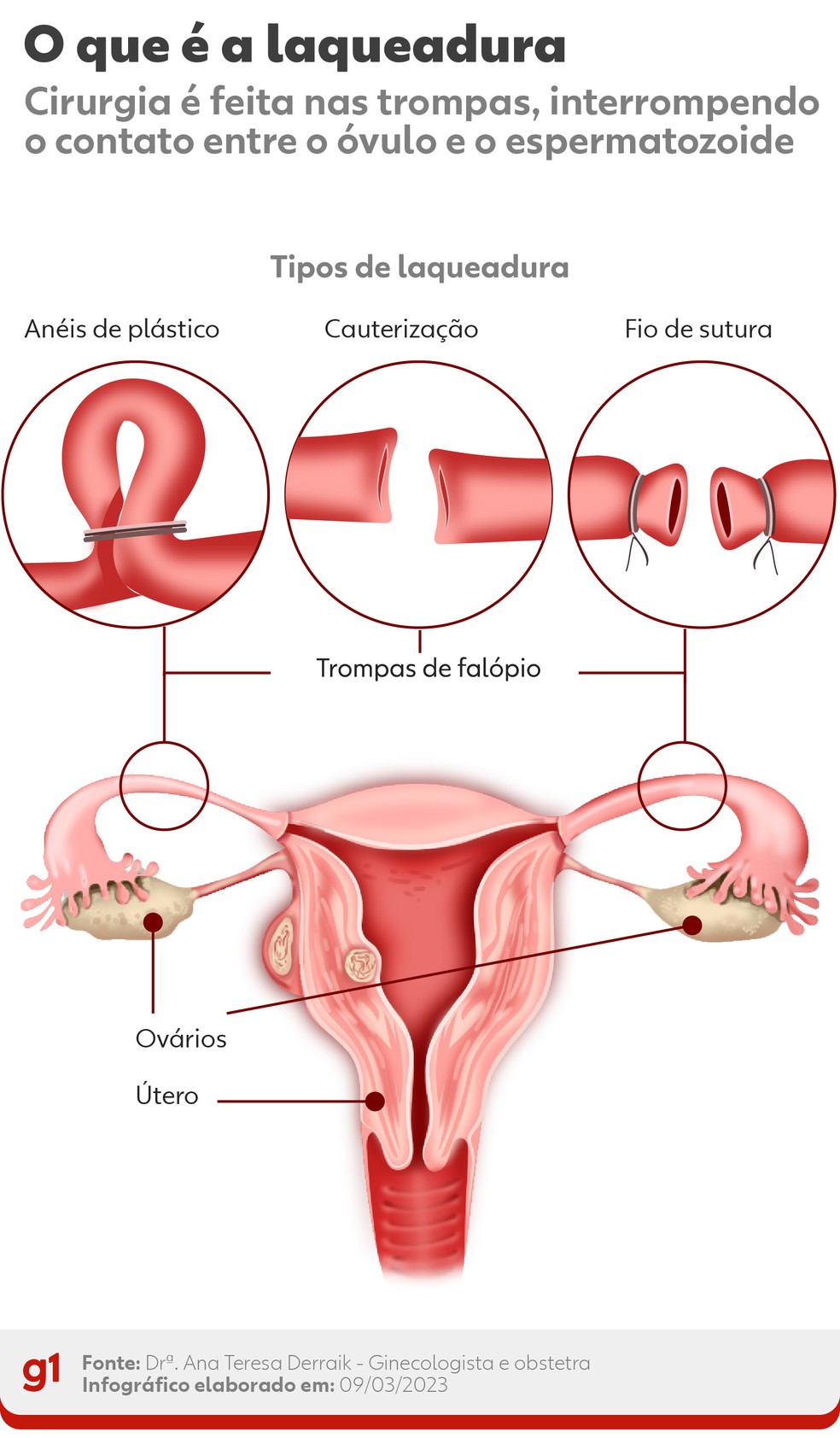 arrependimento após laqueadura o que fazer