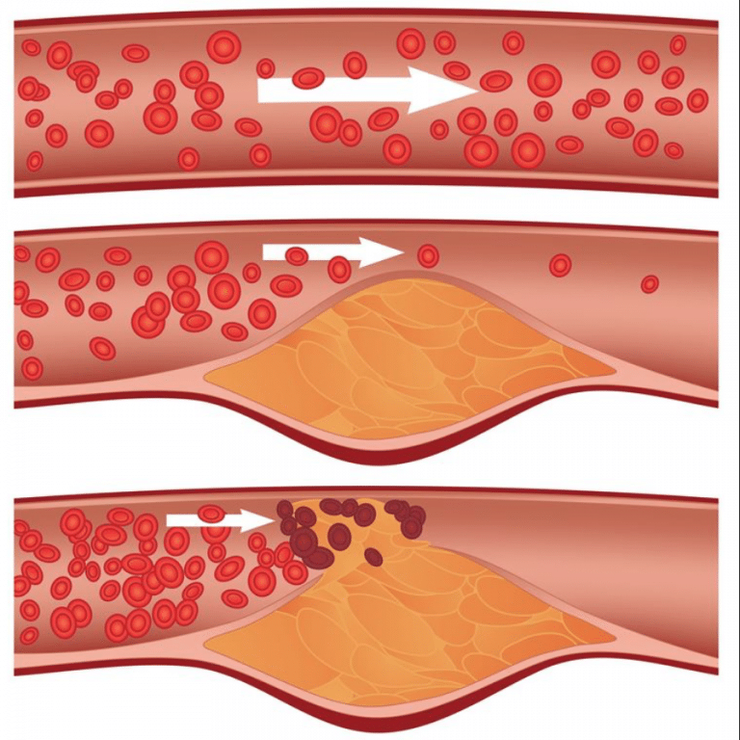 Arterosclerose