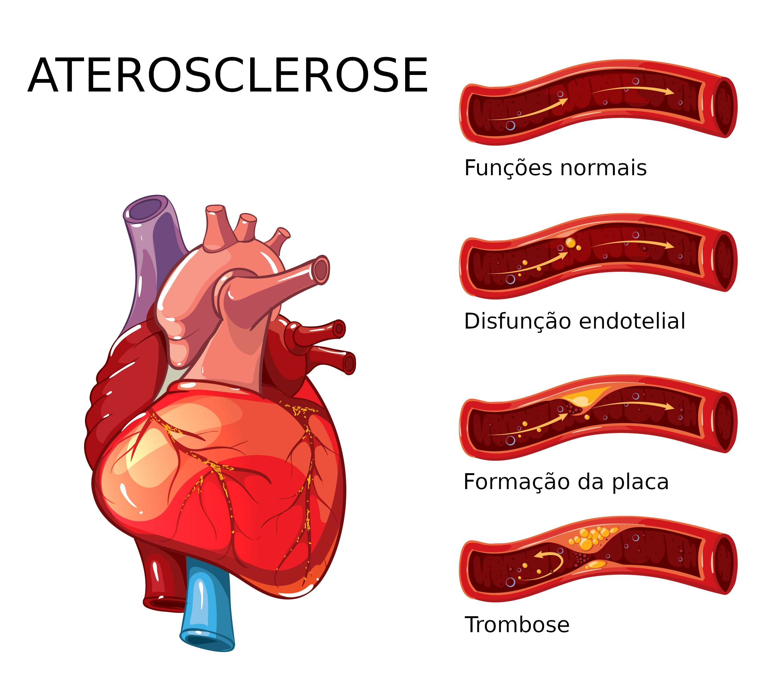 Hipertensão e Diabetes: Como Controlar para Evitar a Arteriosclerose