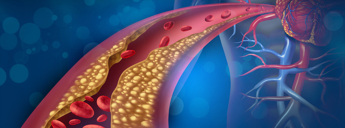 Dieta e Aterosclerose: Alimentos que Ajudam a Prevenir Placas nas Artérias
