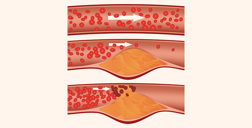 Hipertensão e Diabetes: Como Controlar para Evitar a Arteriosclerose