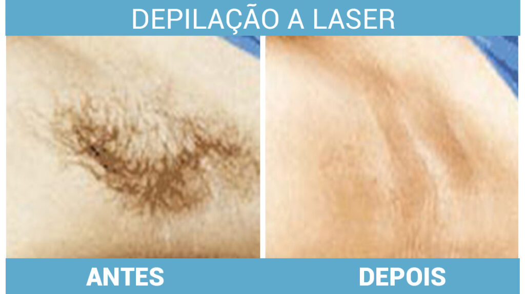 Depilação a Laser vs. Cera: Qual a Melhor Opção para Suas Axilas?