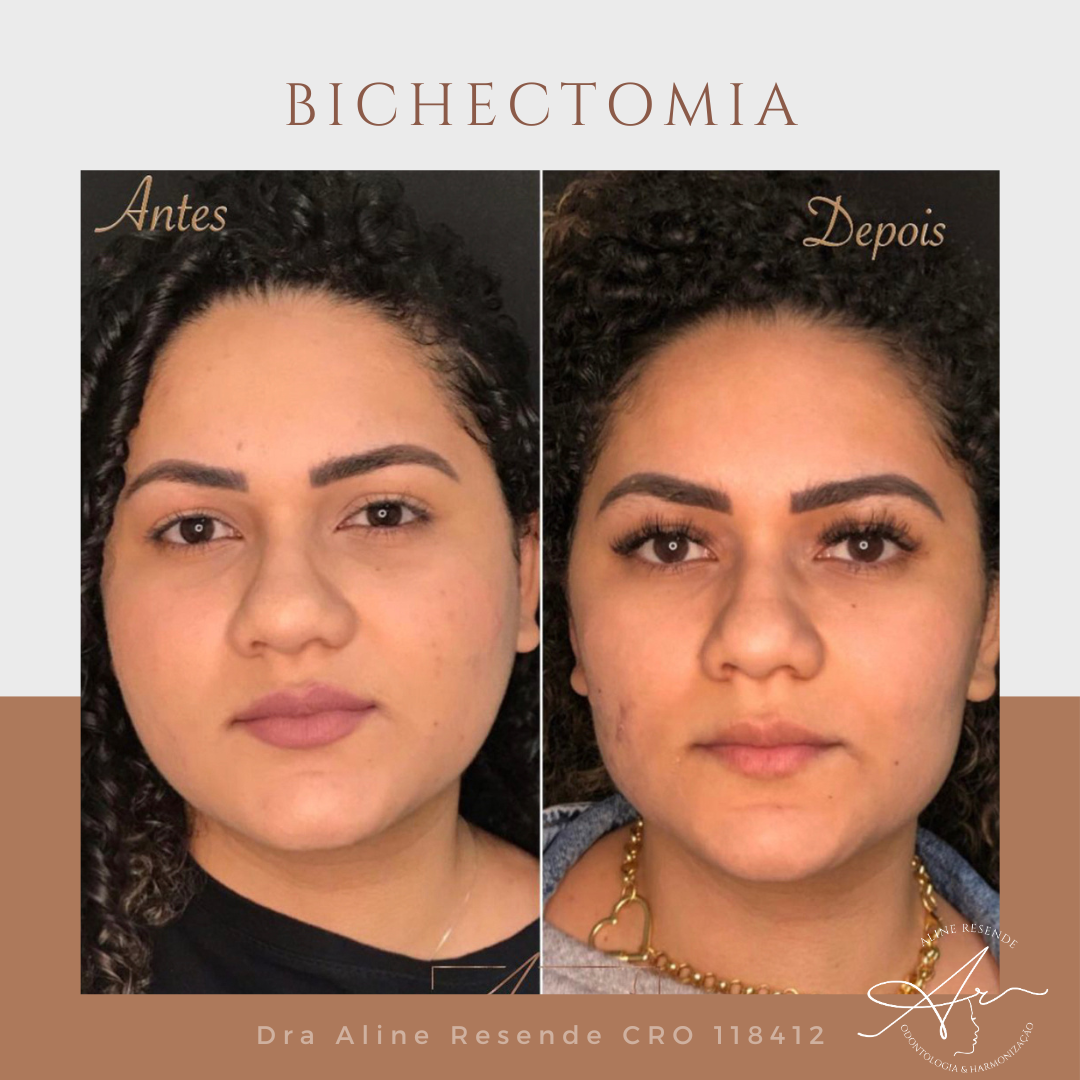 5 ideias de títulos:
1. Bichectomia: O Que Você Precisa Saber Antes de Fazer
2. Antes e Depois da Bichectomia: Expectativas vs. Realidade
3. Riscos e Complicações da Bichectomia: O Que os Pacientes Relatam
4. Bichectomia: É Possível Reverter os Efeitos?
5. Harmonização Facial: A Bichectomia é a Escolha Certa Para Você?