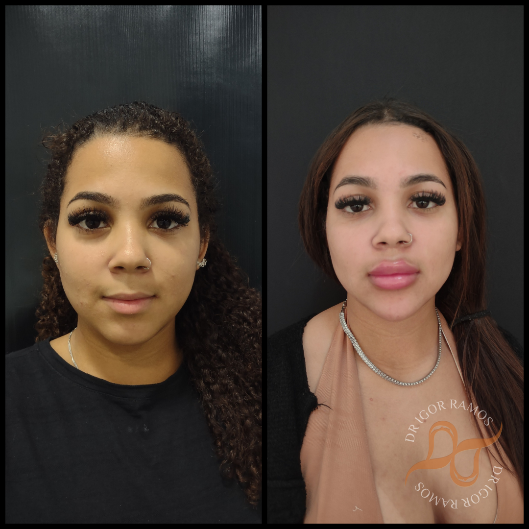 Bichectomia Antes E Depois