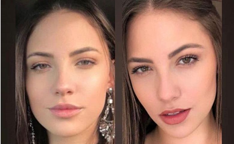 Bichectomia Antes E Depois