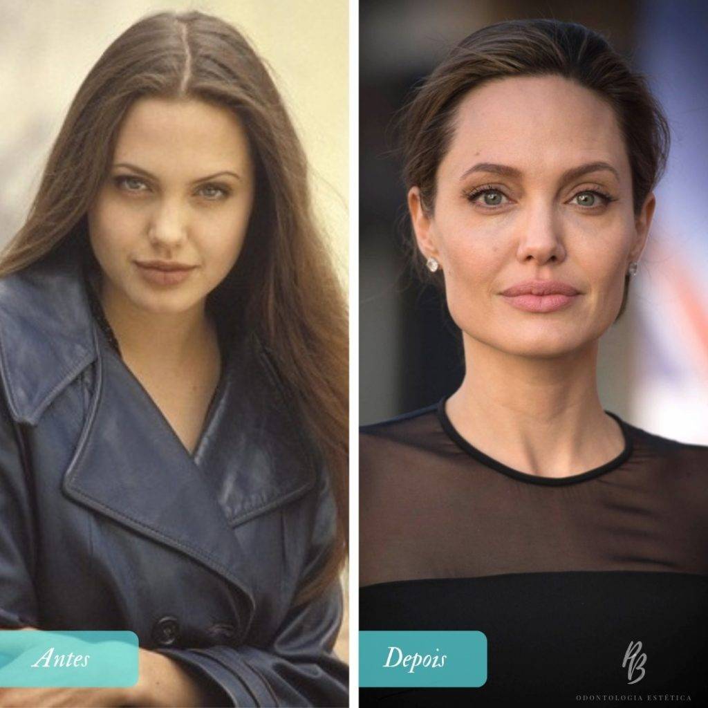 5 ideias de títulos:
1. Bichectomia: O Que Você Precisa Saber Antes de Fazer
2. Antes e Depois da Bichectomia: Expectativas vs. Realidade
3. Riscos e Complicações da Bichectomia: O Que os Pacientes Relatam
4. Bichectomia: É Possível Reverter os Efeitos?
5. Harmonização Facial: A Bichectomia é a Escolha Certa Para Você?