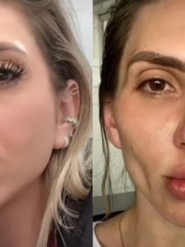 Bichectomia Antes E Depois