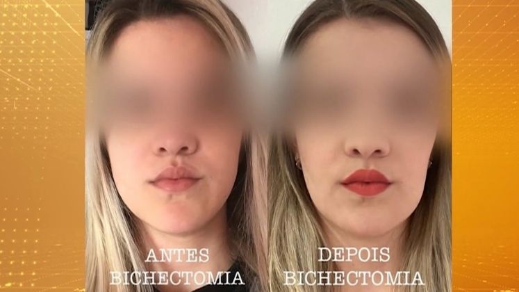 Bichectomia Antes E Depois