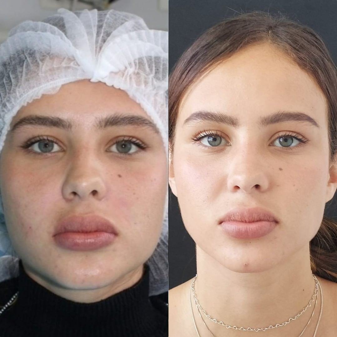 Bichectomia Antes E Depois