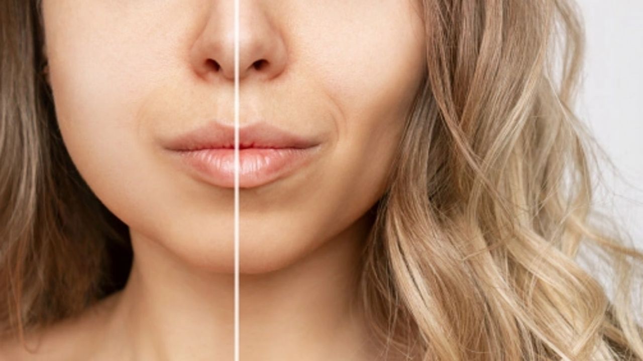 Bichectomia Antes E Depois