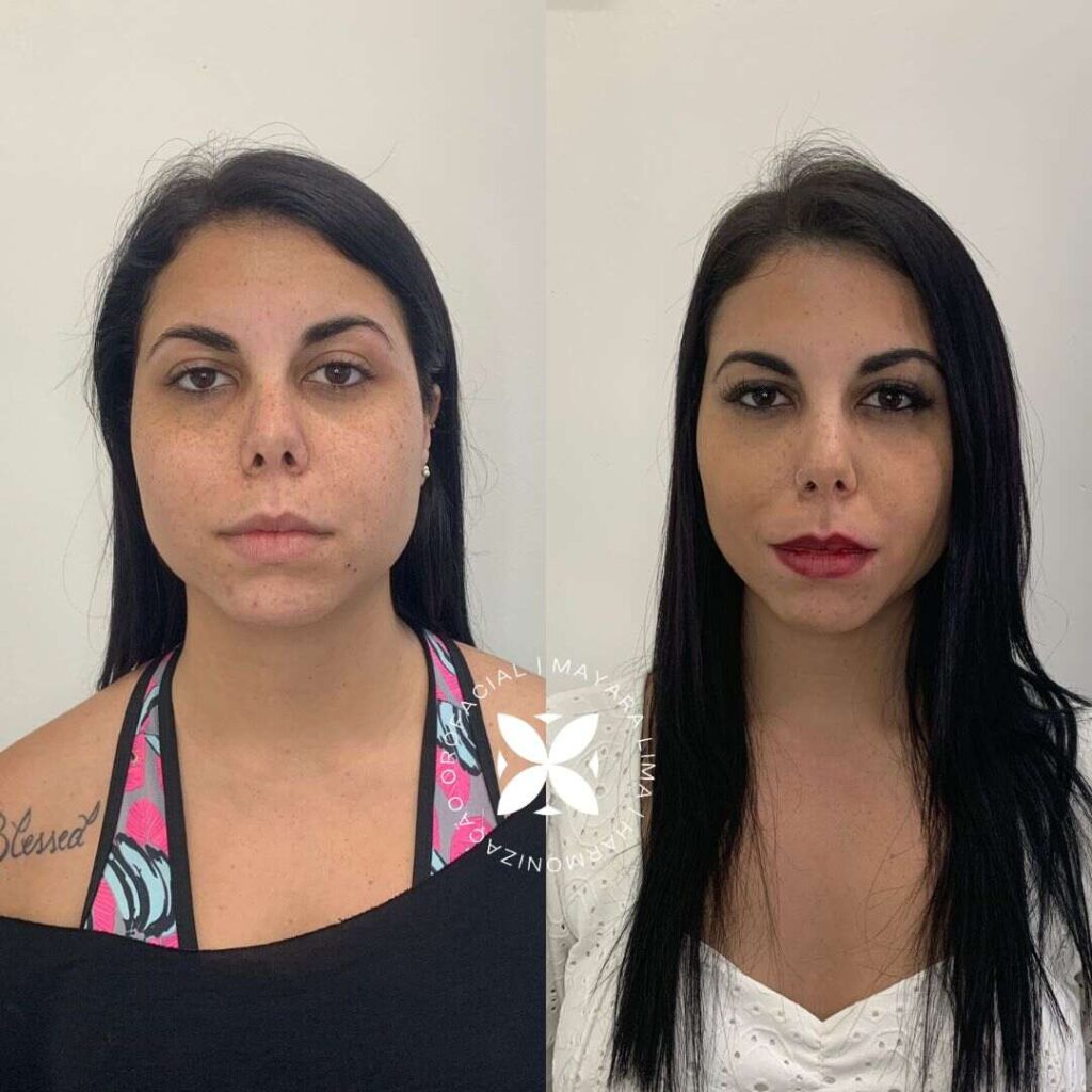 5 ideias de títulos:
1. Bichectomia: O Que Você Precisa Saber Antes de Fazer
2. Antes e Depois da Bichectomia: Expectativas vs. Realidade
3. Riscos e Complicações da Bichectomia: O Que os Pacientes Relatam
4. Bichectomia: É Possível Reverter os Efeitos?
5. Harmonização Facial: A Bichectomia é a Escolha Certa Para Você?