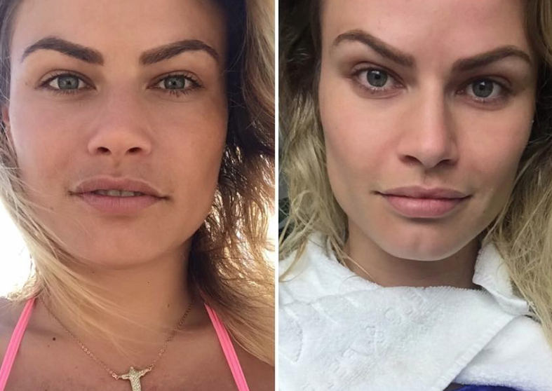 Bichectomia Antes E Depois