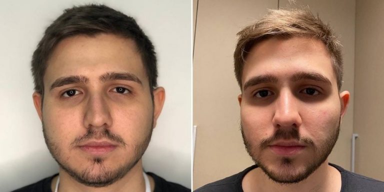 5 ideias de títulos:
1. Bichectomia: O Que Você Precisa Saber Antes de Fazer
2. Antes e Depois da Bichectomia: Expectativas vs. Realidade
3. Riscos e Complicações da Bichectomia: O Que os Pacientes Relatam
4. Bichectomia: É Possível Reverter os Efeitos?
5. Harmonização Facial: A Bichectomia é a Escolha Certa Para Você?