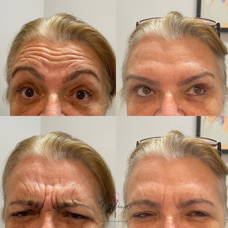 botox antes e depois