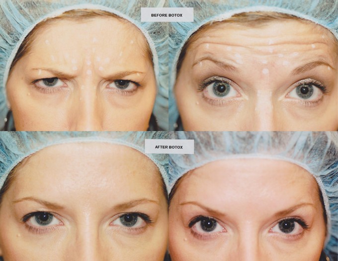 Botox Full Face: O Guia Completo para um Contorno Facial Definido