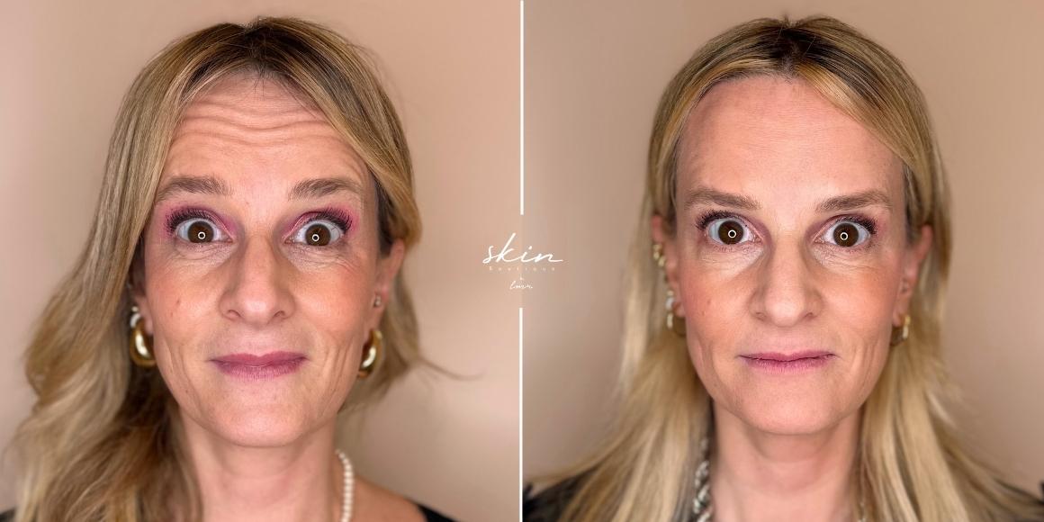 Botox Preventivo: Começar aos 20 Anos Realmente Evita Rugas Profundas?