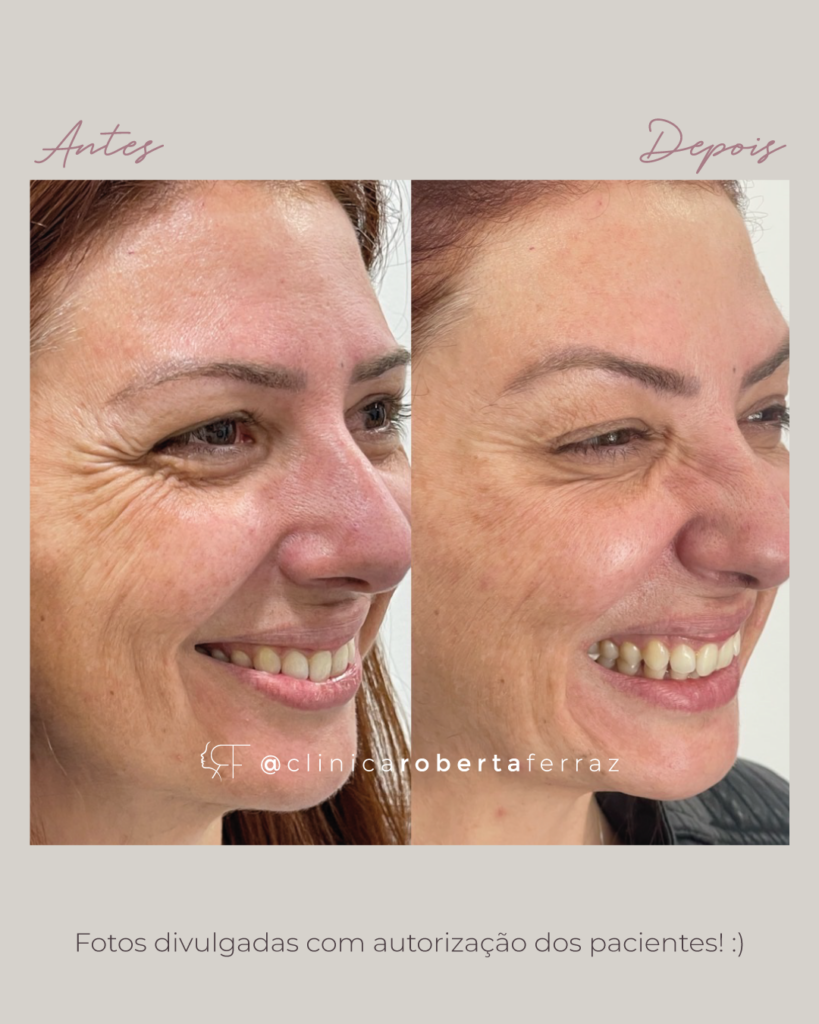 Pós-Botox: 7 Cuidados Essenciais para Maximizar a Duração do seu Resultado