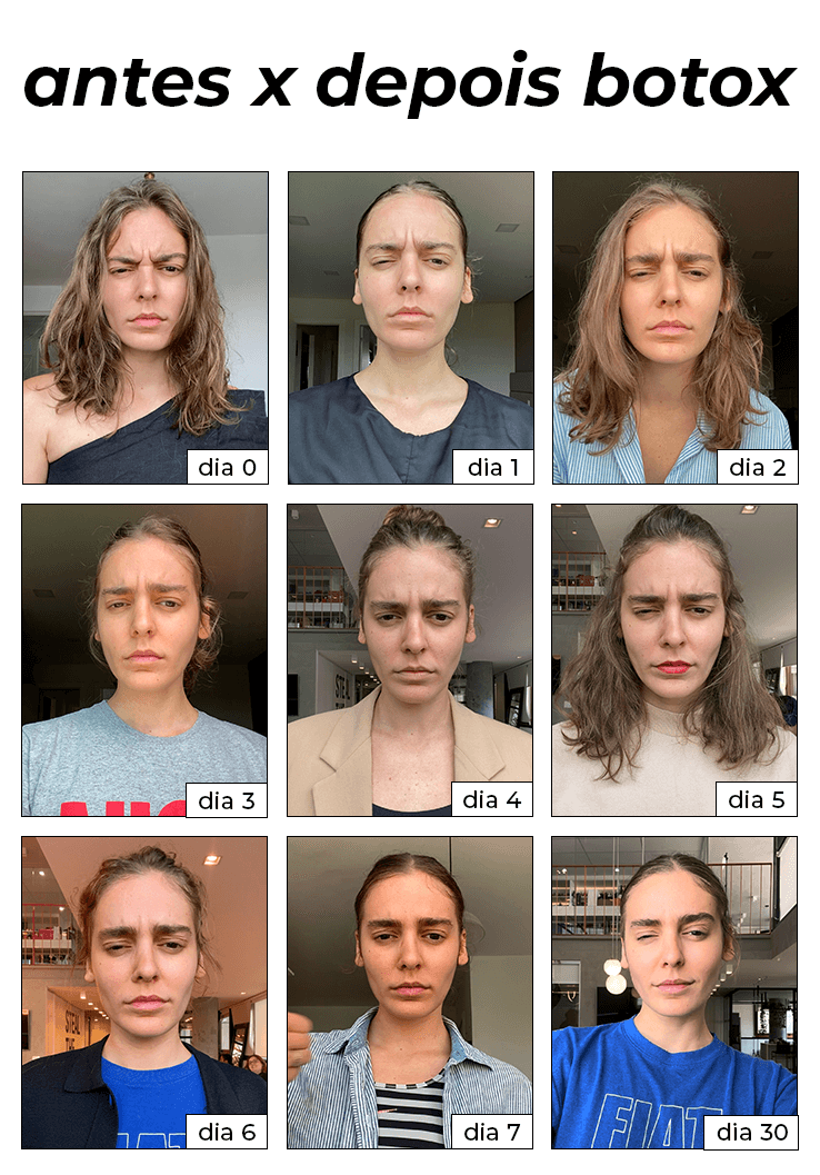 Preço do Botox: O Que Influencia o Custo da Sessão e Como Encontrar um Profissional Qualificado