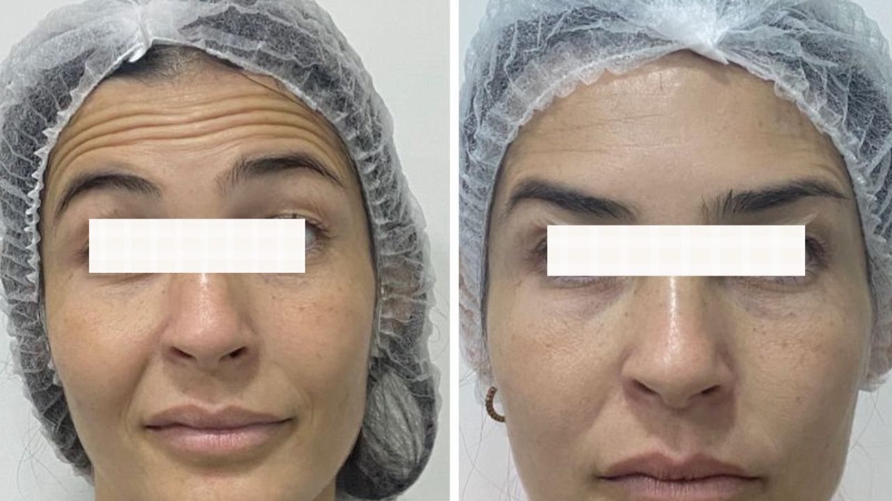 botox antes e depois