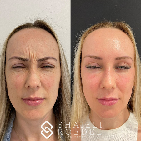 Botox Full Face: O Guia Completo para um Contorno Facial Definido