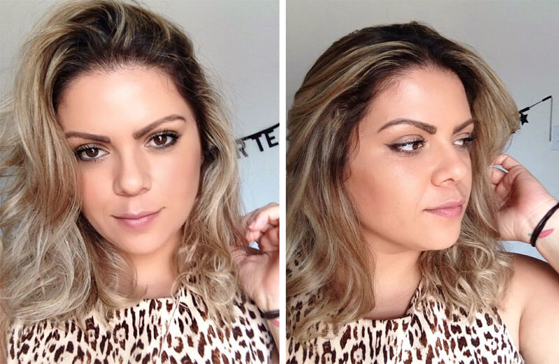 Botox Preventivo: Começar aos 20 Anos Realmente Evita Rugas Profundas?