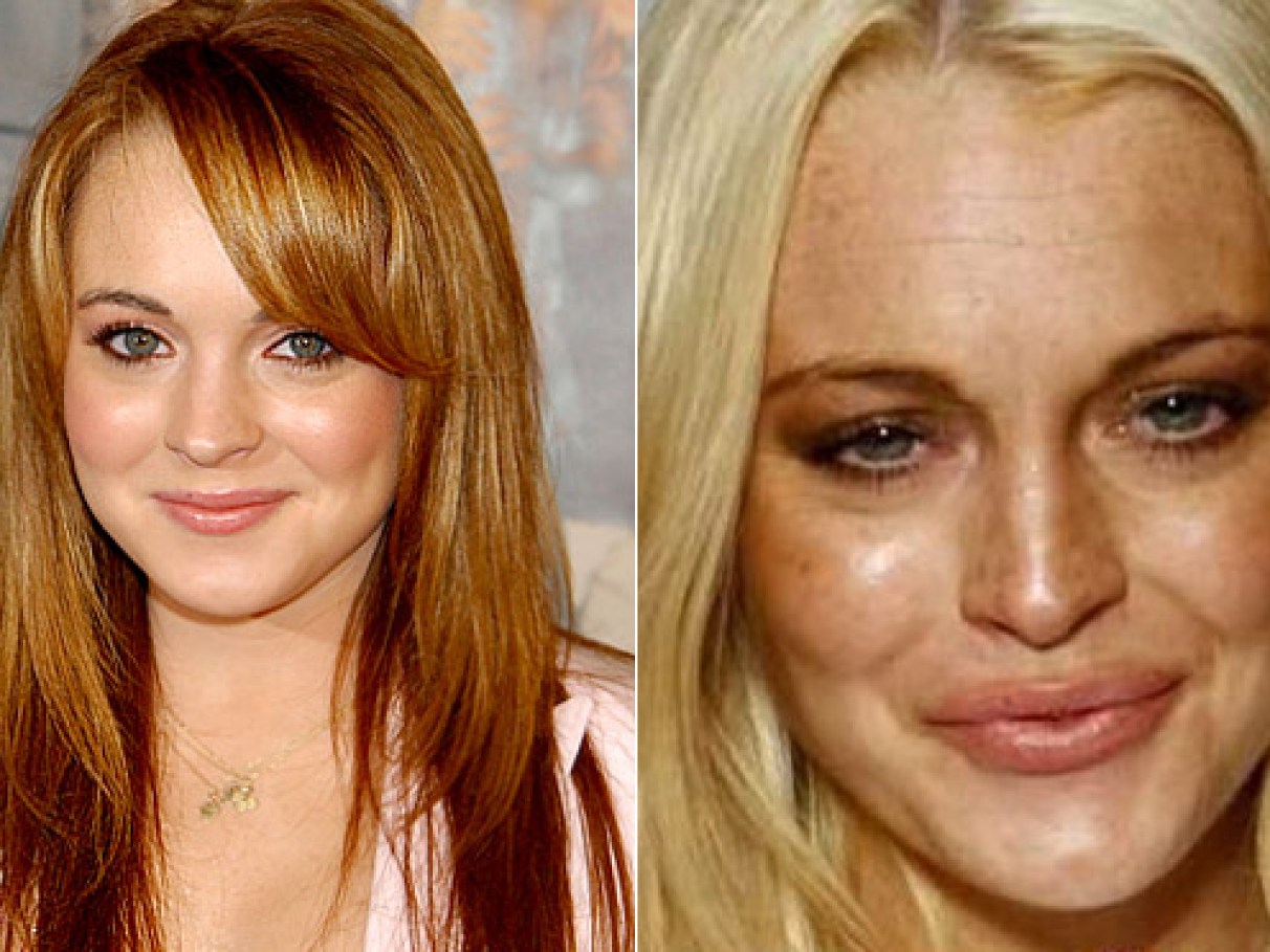 Pós-Botox: 7 Cuidados Essenciais para Maximizar a Duração do seu Resultado