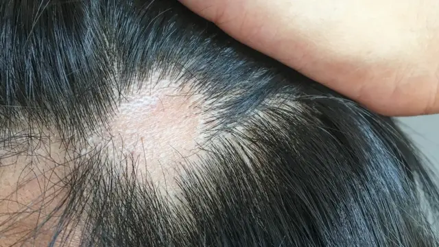 Hipotireoidismo e Queda de Cabelo: Entenda a Conexão e Como Tratar
