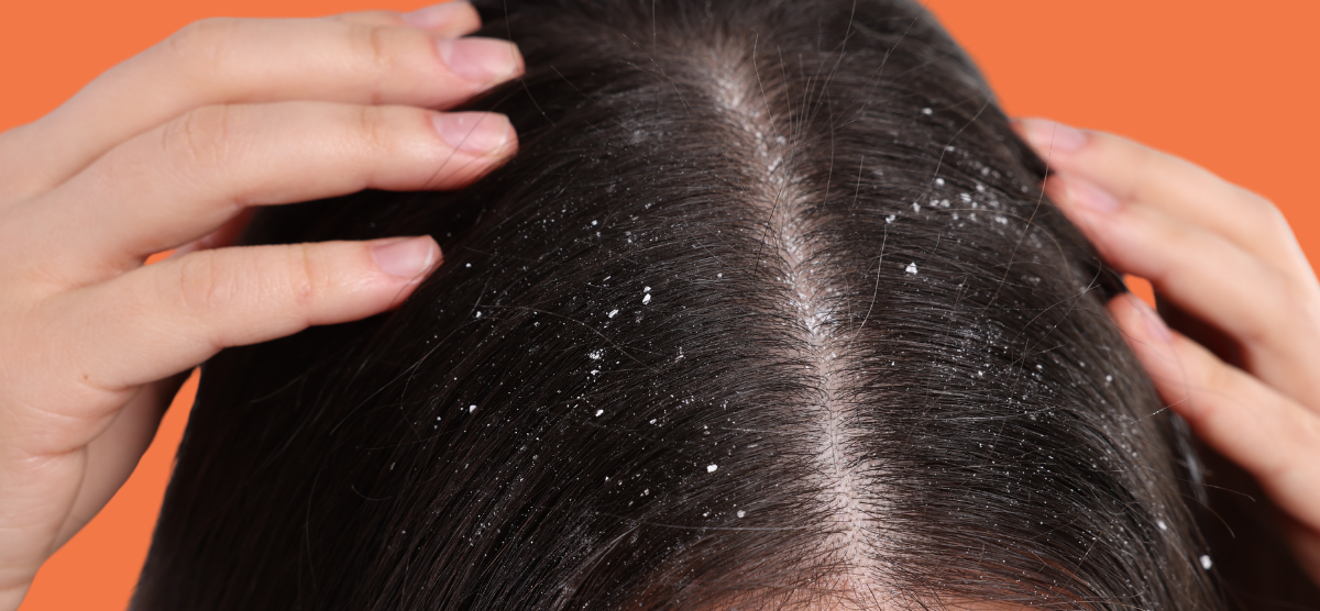 Vitaminas Essenciais para Prevenir a Queda de Cabelo: Guia Completo