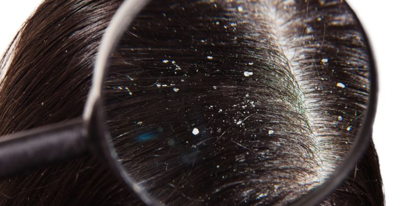 SOS Cabelo Oleoso: 7 truques para disfarçar a raiz sem lavar