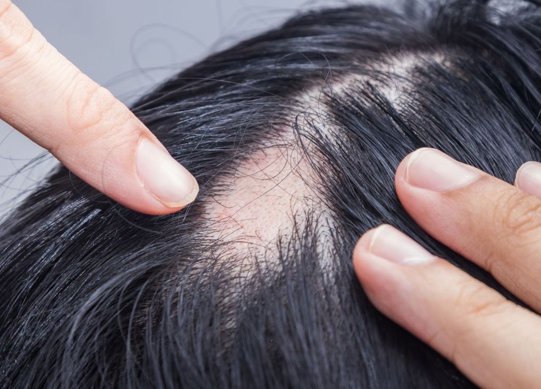 Guia Completo: Entendendo a Alopecia Areata e Seus Tratamentos