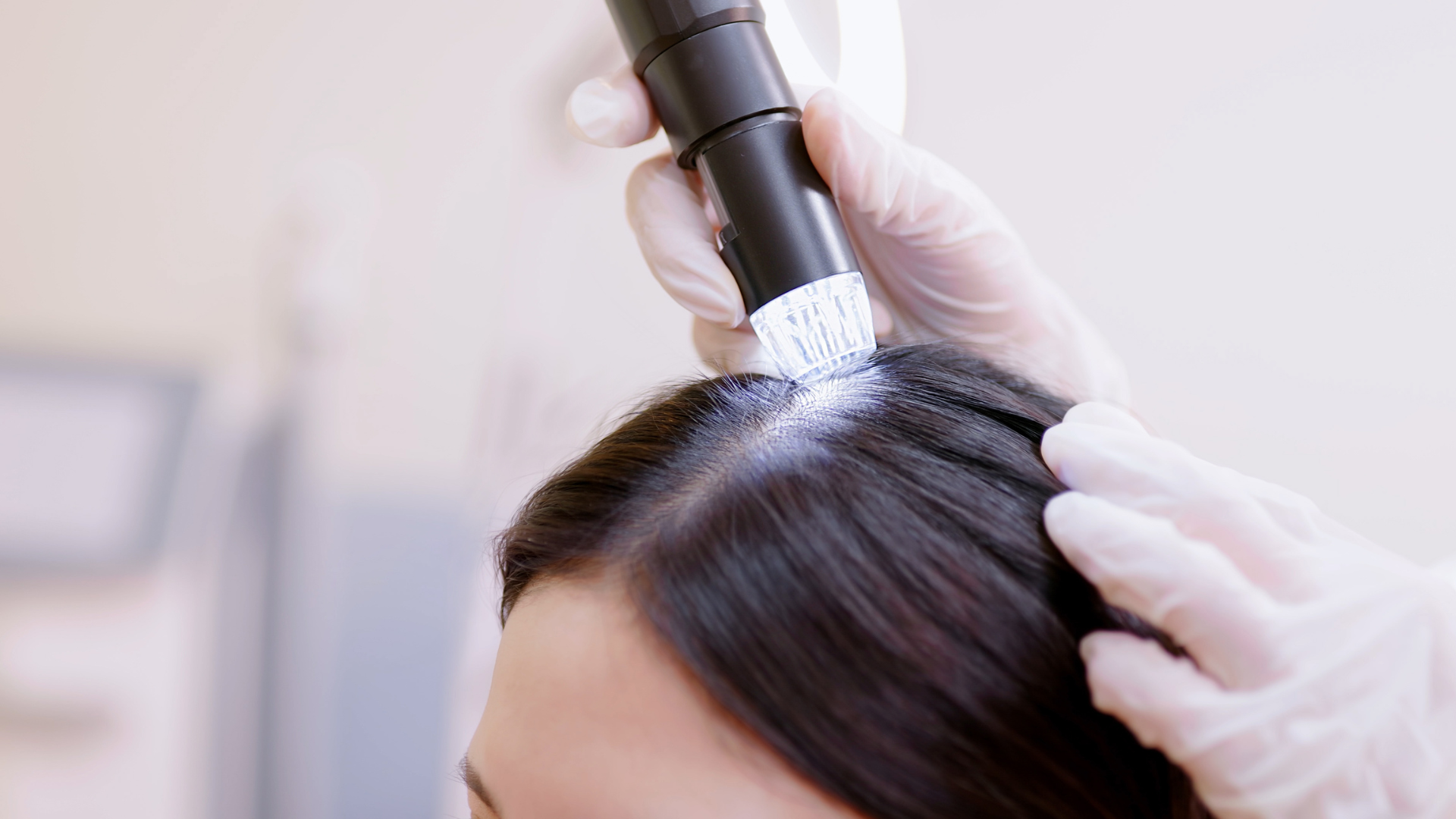 Os Benefícios da Microinfusão de Medicamentos na Pele (MMP) para Queda Capilar