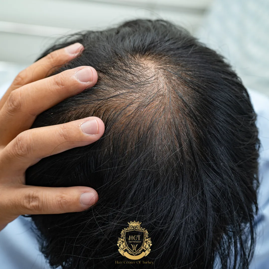 Os Benefícios da Microinfusão de Medicamentos na Pele (MMP) para Queda Capilar