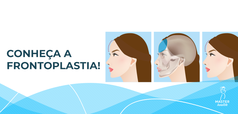 Frontoplastia vs. Transplante Capilar: Qual o melhor para você?