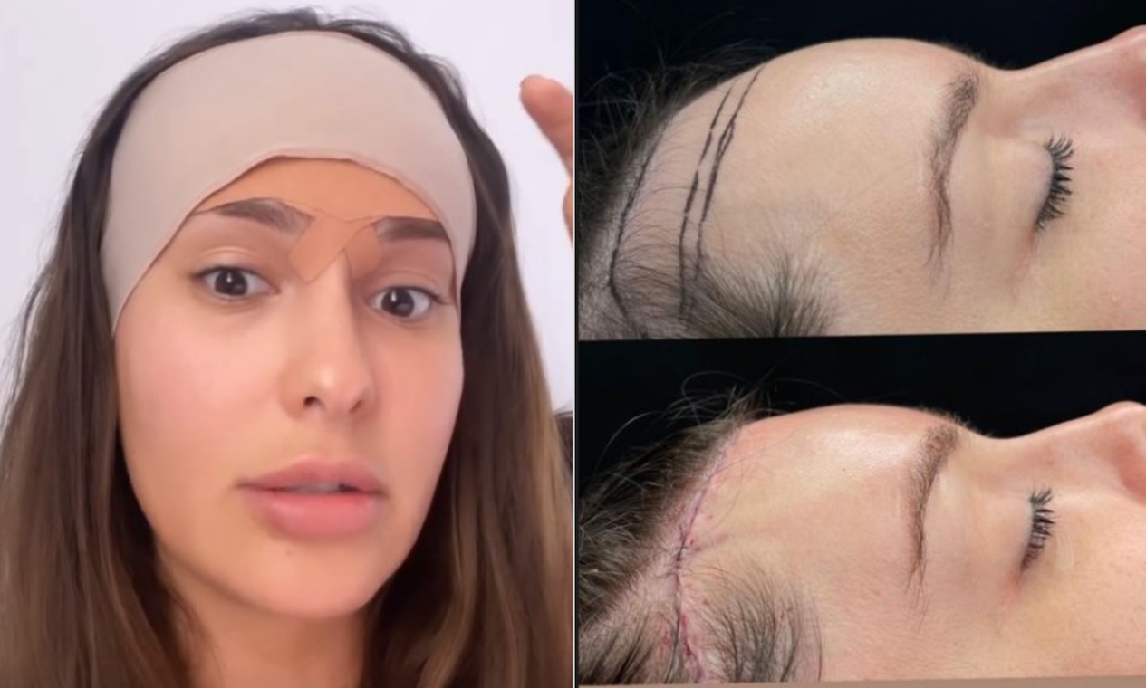 Técnicas FUE e FUT: Entenda os tipos de transplante capilar