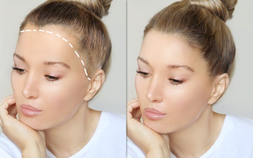 Redução de Testa: O que esperar do pós-operatório e acompanhamento