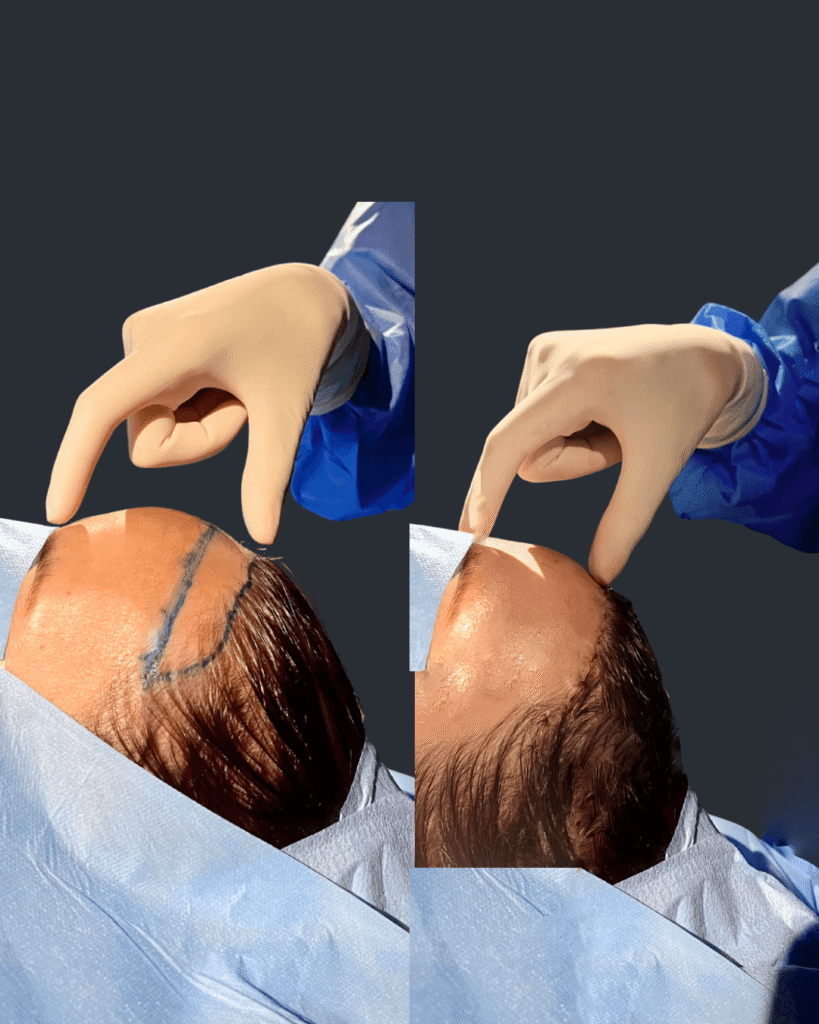 Clínica de frontoplastia e transplante capilar